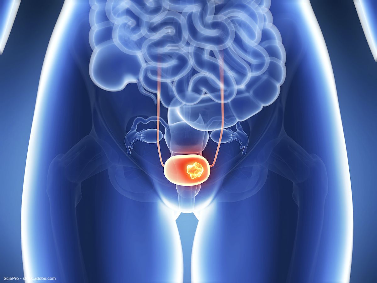 illustration of bladder cancer