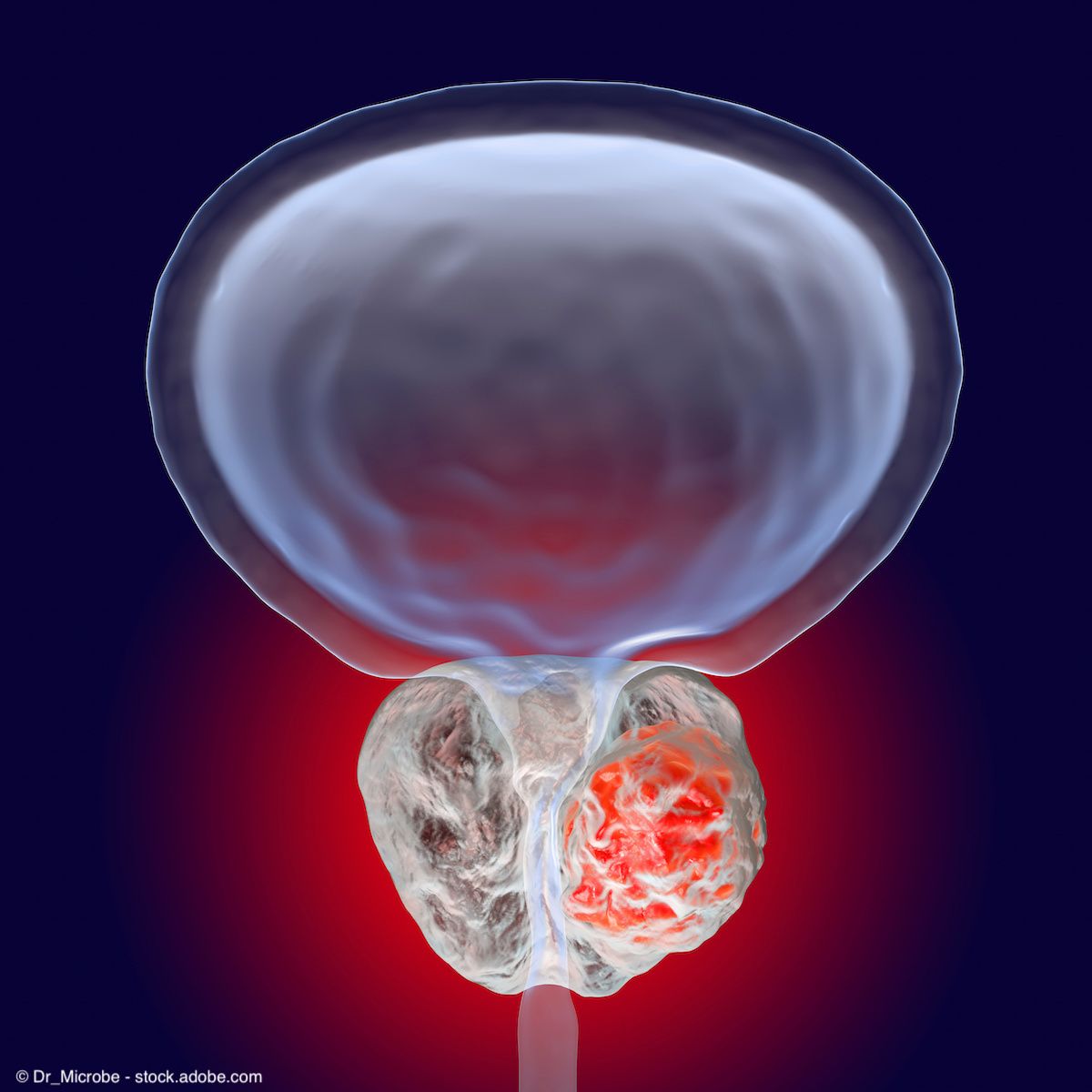 Patents expand production of Gallium-68 for prostate cancer