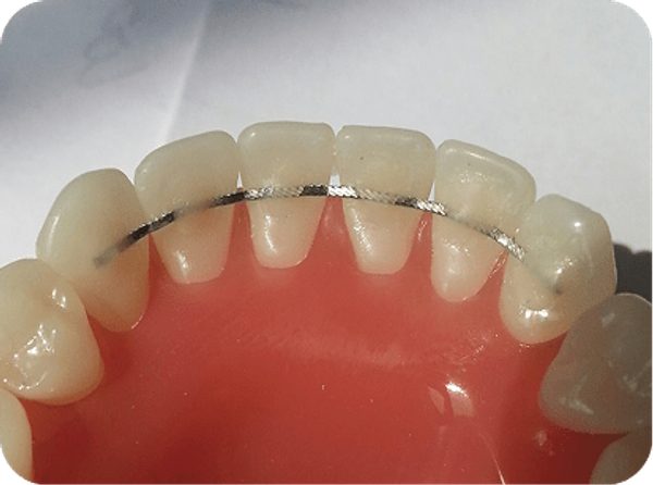 fixed retainer