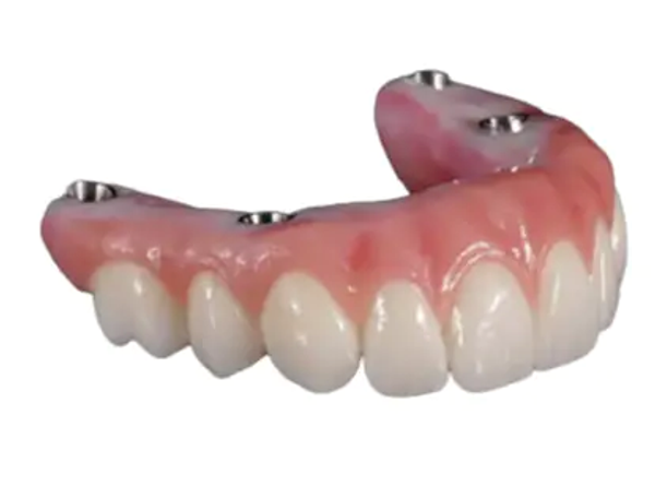 Implant retained dentures