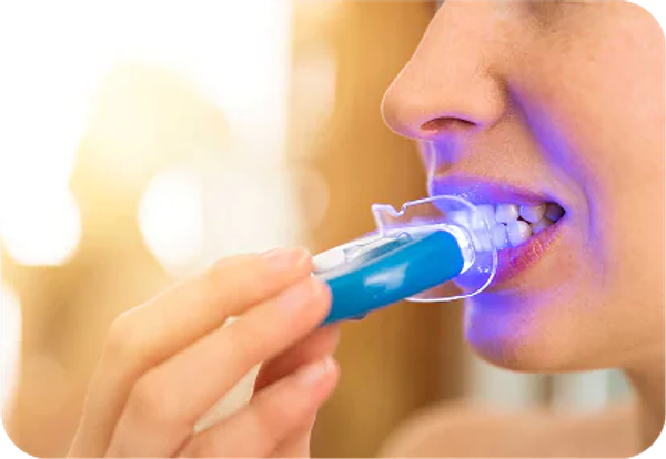 Home Based Bleaching Trays