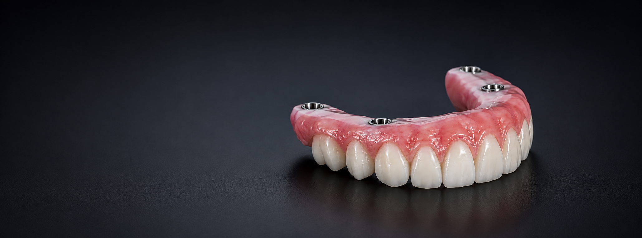 Implant Retained Dentures