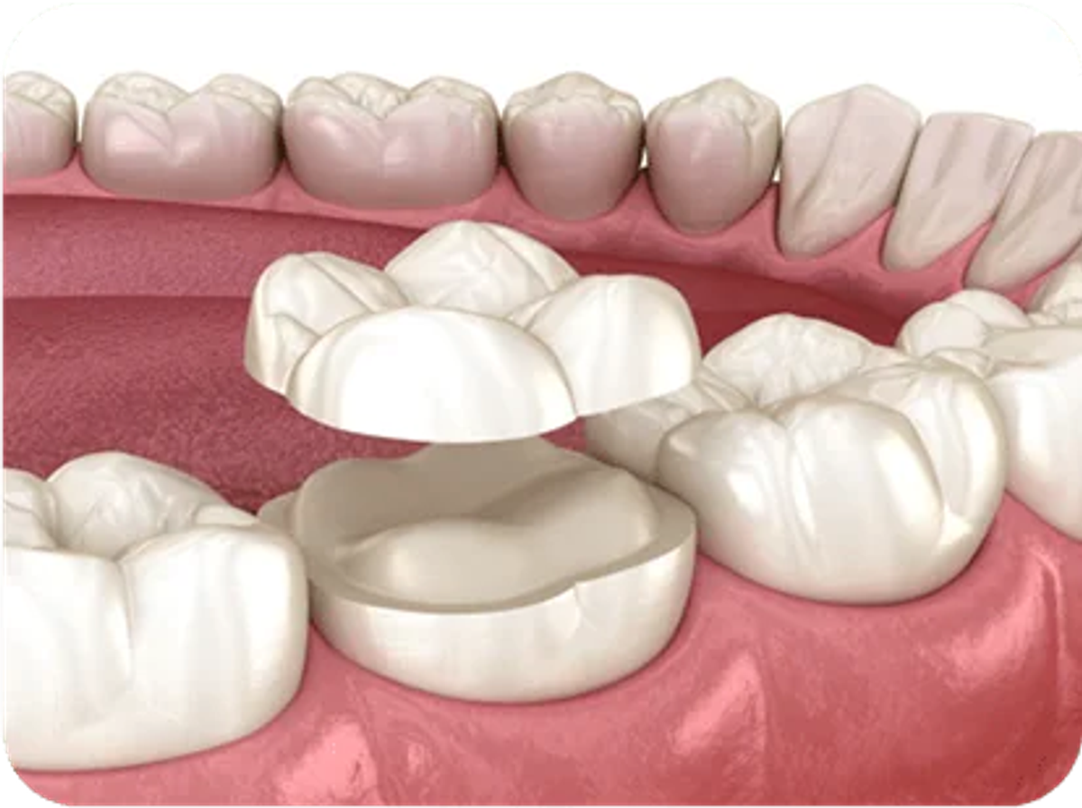 Dental Restorations in Kingswood and Penrith