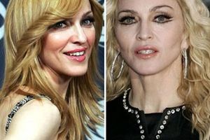 Celebrities who have become victims of plastic surgery