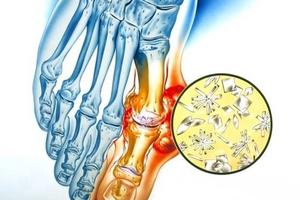 Helpful tips for gout