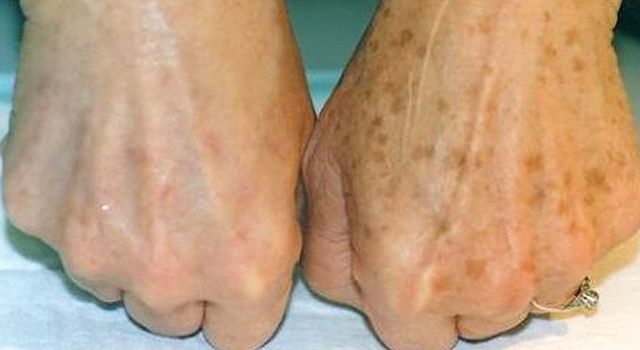 An easy way to remove dark spots on the skin of the hands