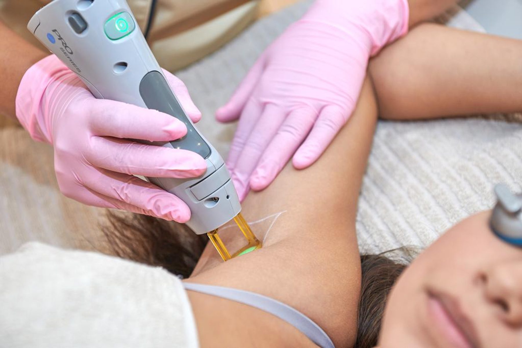 definitieve laserontharing