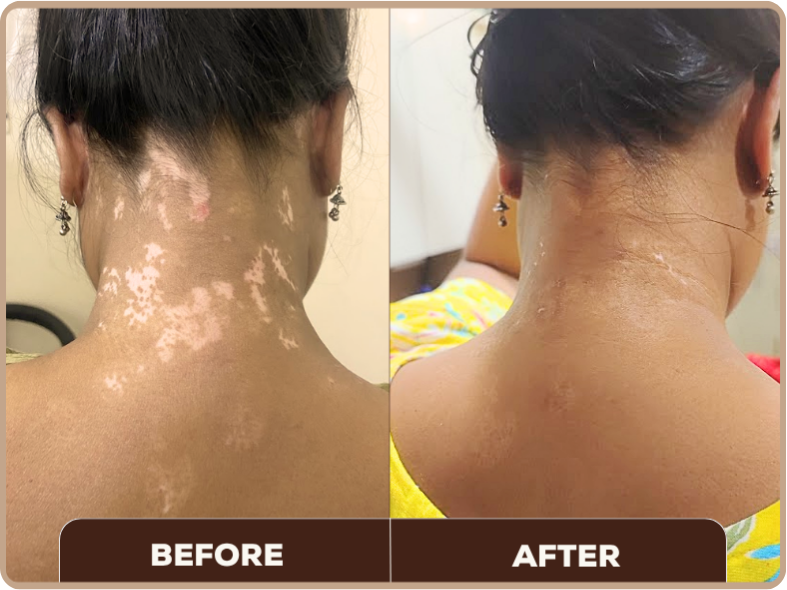 Vitiligo before and after at Dermaheal