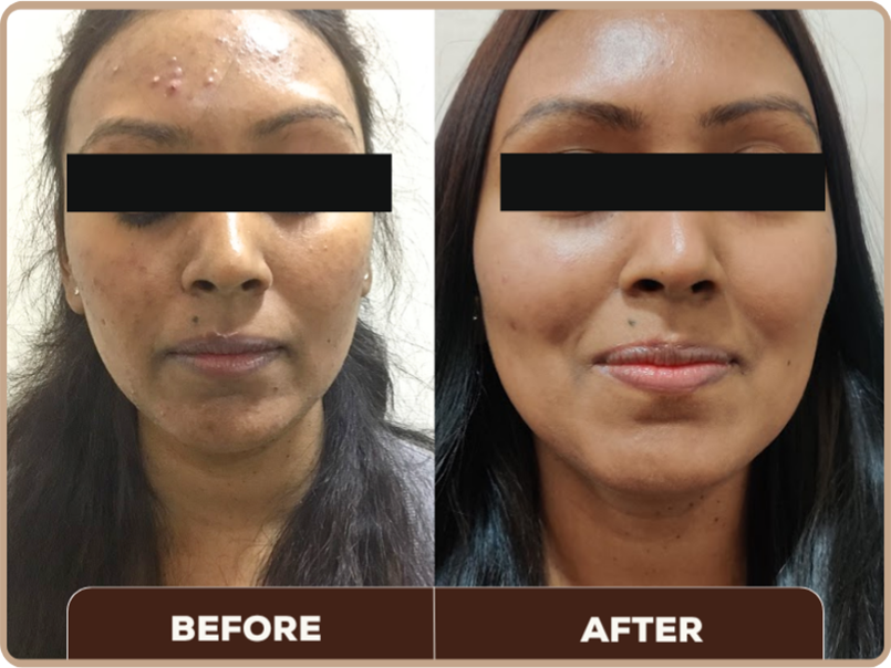 Chemical Peel before and after at Dermaheal