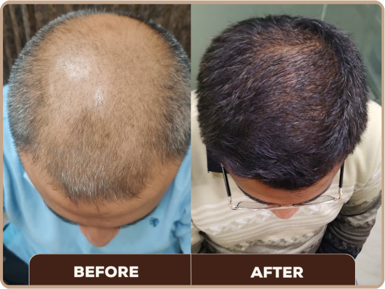 MPHL Treatment before and after at Dermaheal