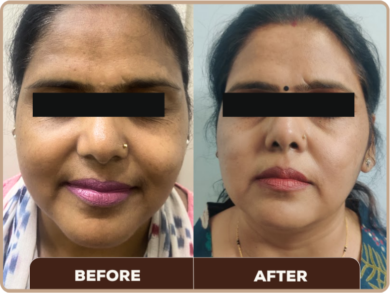 Cosmelan for Melasma before and after at Dermaheal
