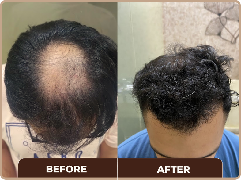 Hair PRP Treatment before and after at Dermaheal