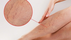 Bài tập yoga chữa giãn tĩnh mạch chân