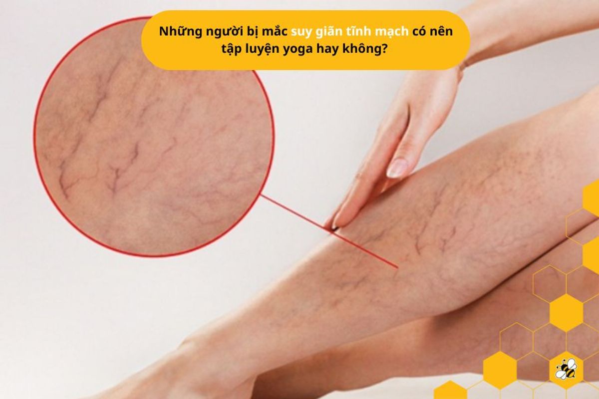 Những người bị mắc suy giãn tĩnh mạch có nên tập luyện yoga hay không?