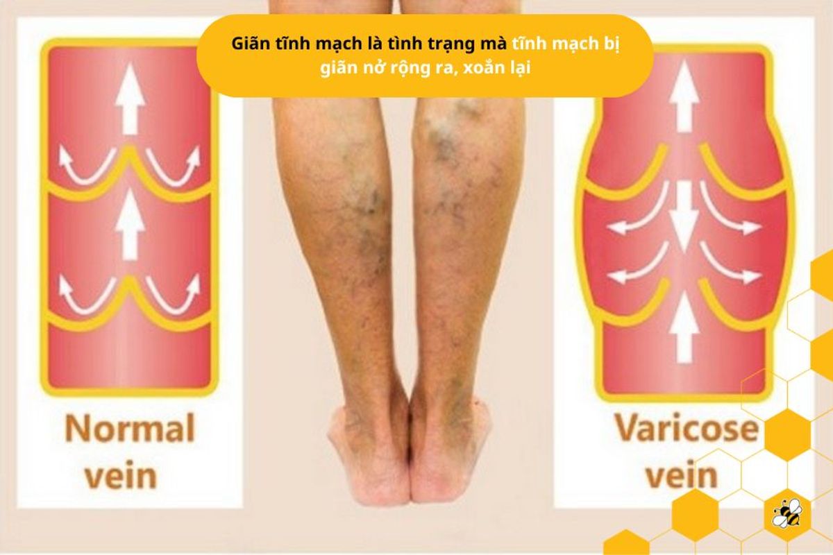Giãn tĩnh mạch là tình trạng mà tĩnh mạch bị giãn nở rộng ra, xoắn lại