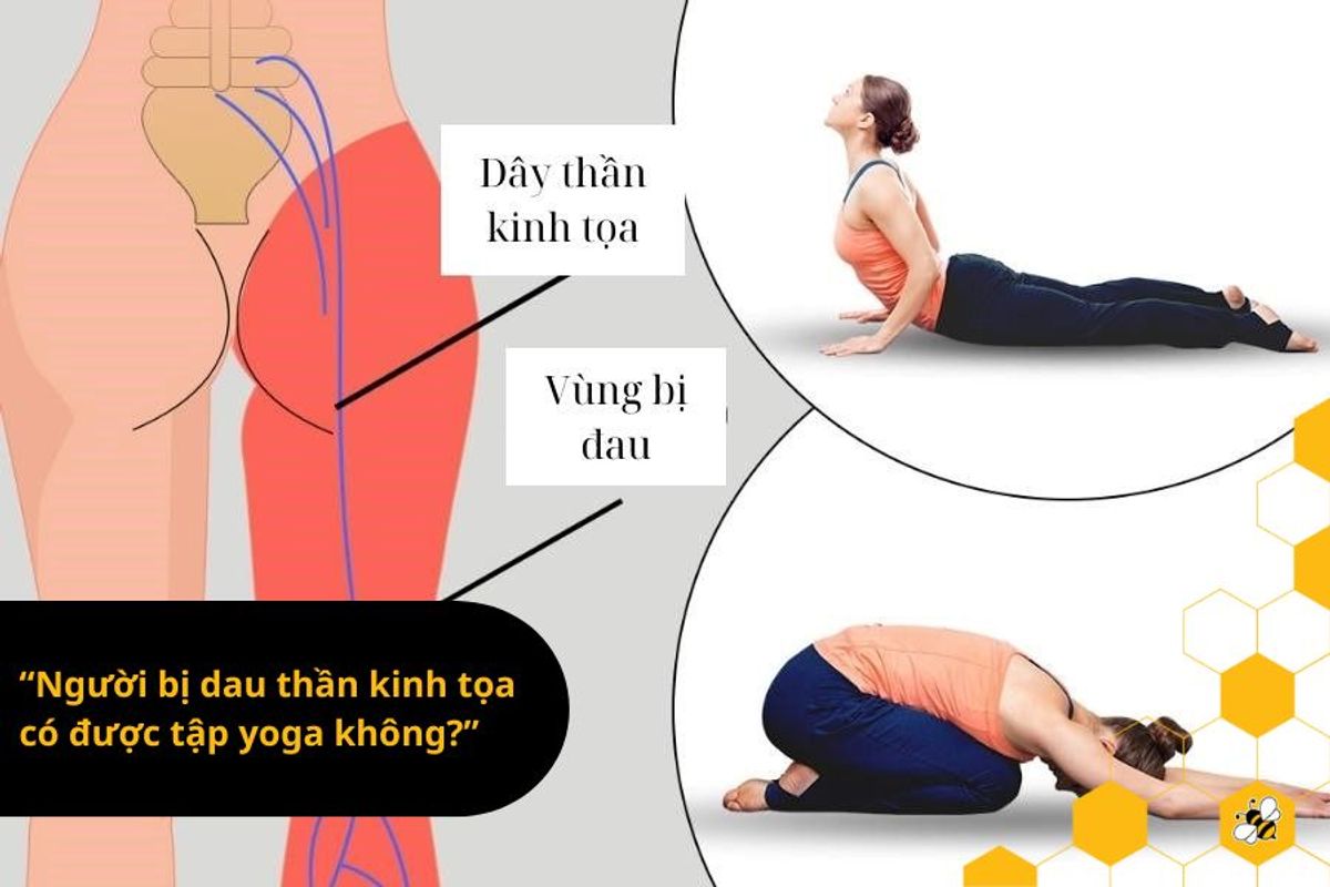 “Người bị dau thần kinh tọa có được tập yoga không?”