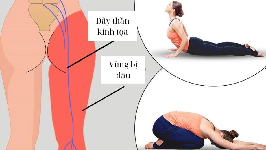 Bài tập yoga chữa đau thần kinh tọa