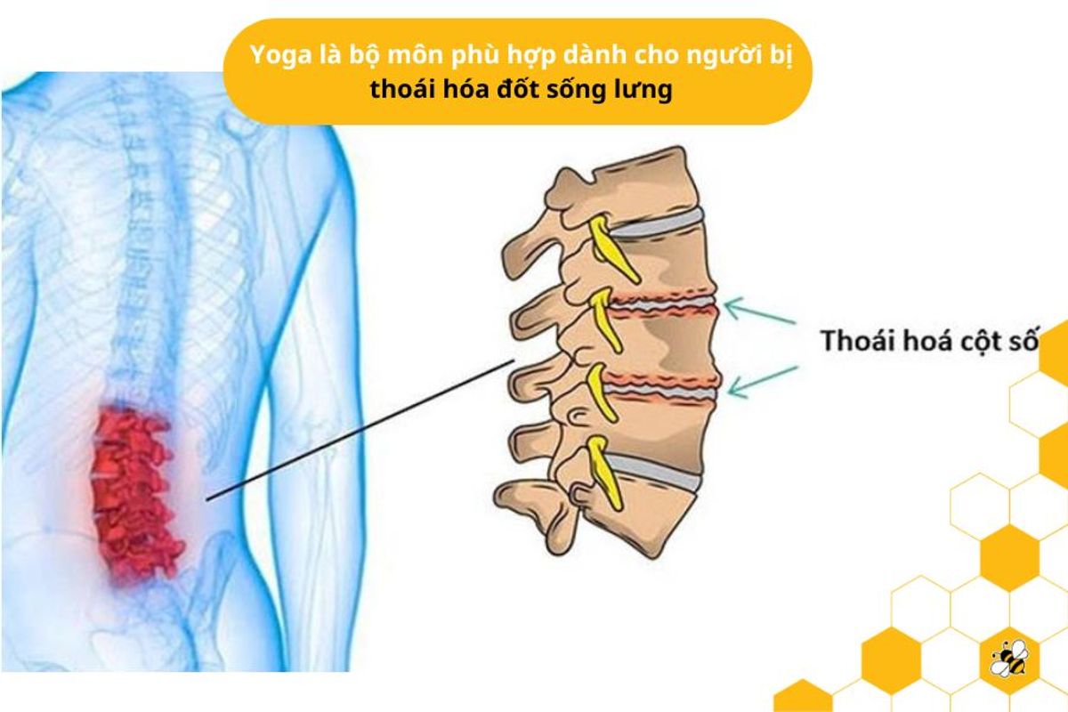 Yoga là bộ môn phù hợp dành cho người bị thoái hóa đốt sống lưng