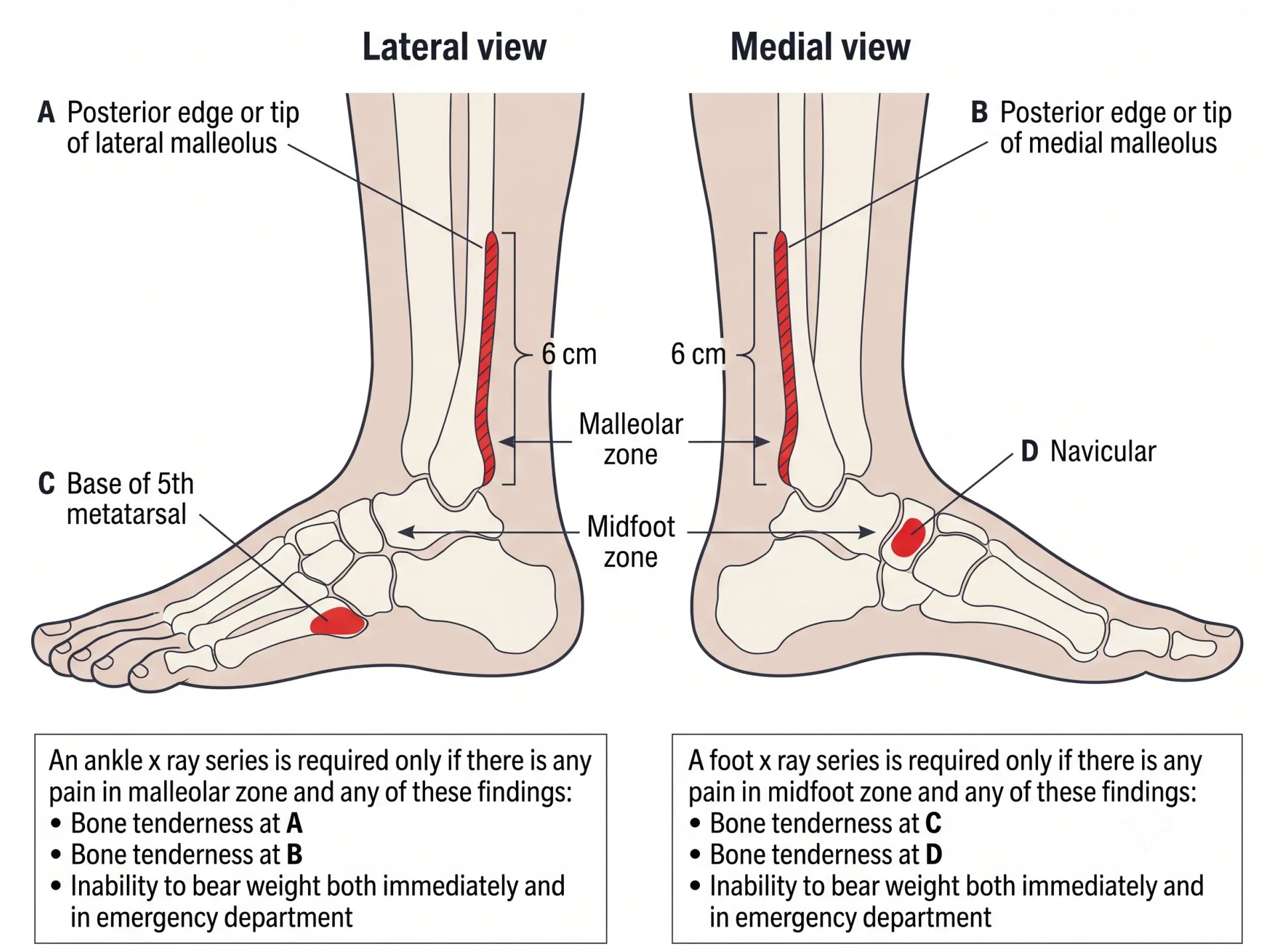 Ottawa Ankle Rules diagram showing the malleolar and midfoot zones, bone tenderness points A to D, and the weight-bearing criteria for X-ray referral.