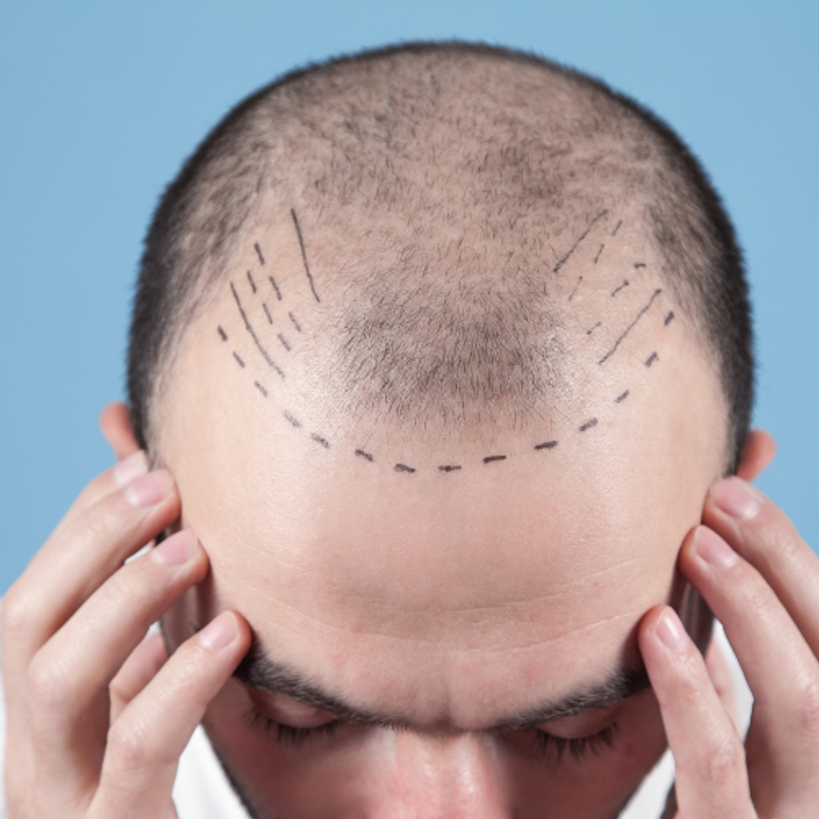 Cómo se Realiza el Diseño de la Línea Frontal para un Implante Capilar