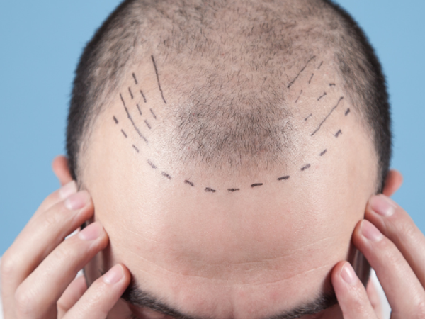 Cómo se Realiza el Diseño de la Línea Frontal para un Implante Capilar