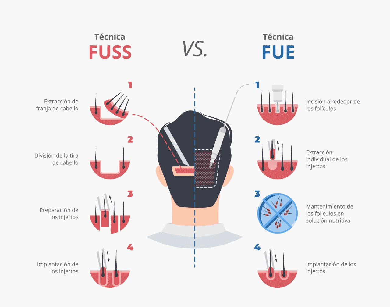 FUE vs FUSS: ¿Cuál es la mejor opción para tu Implante Capilar?