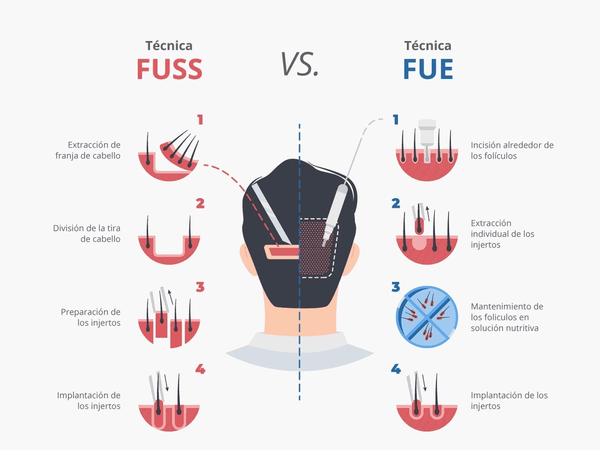 FUE vs FUSS: ¿Cuál es la mejor opción para tu Implante Capilar?