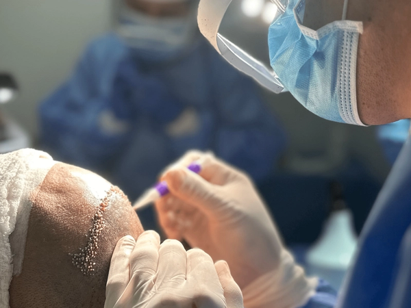 Cuidados Postoperatorios del Implante Capilar