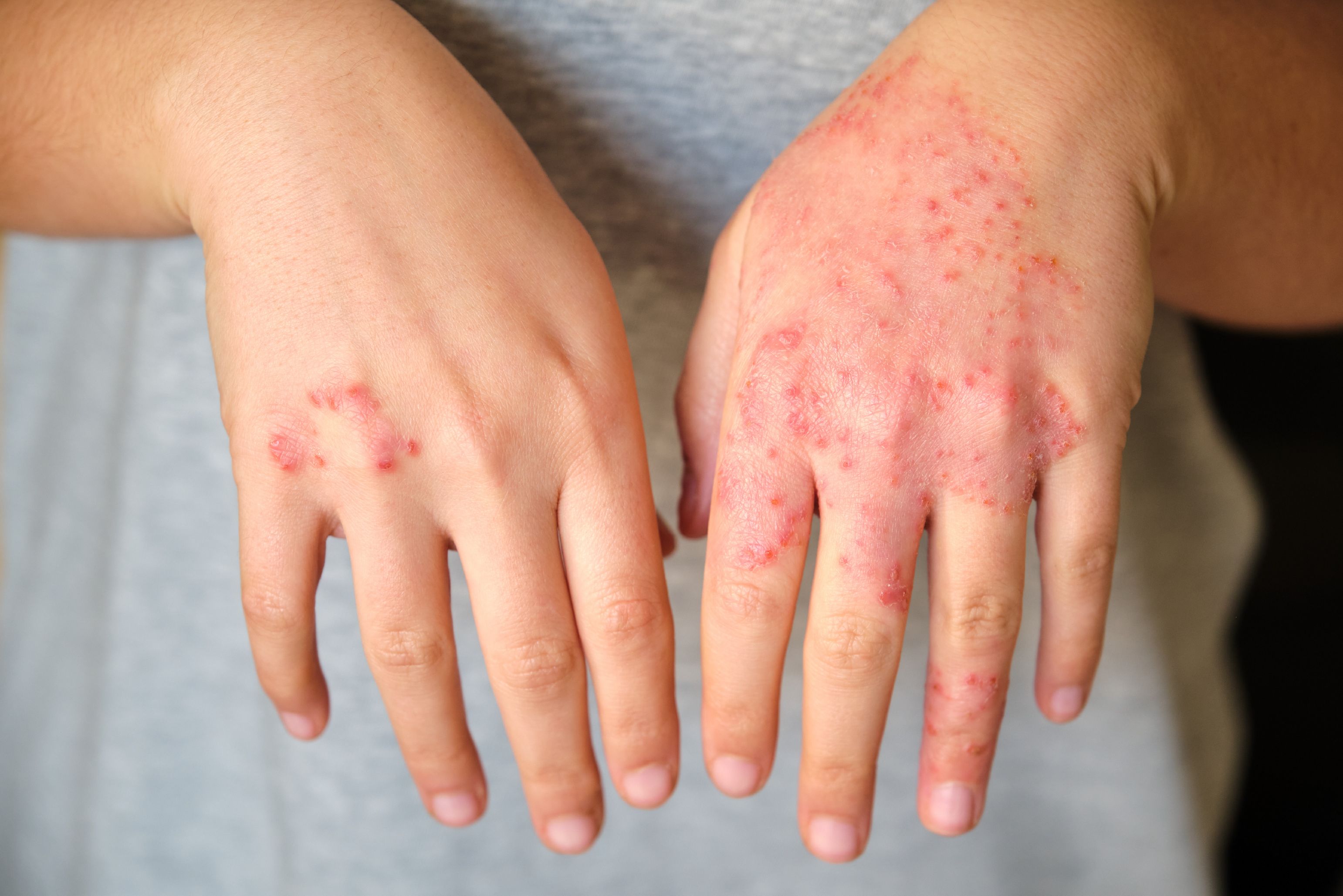 How to Recognise and Manage Mounjaro Skin Rash and Hives in the UK