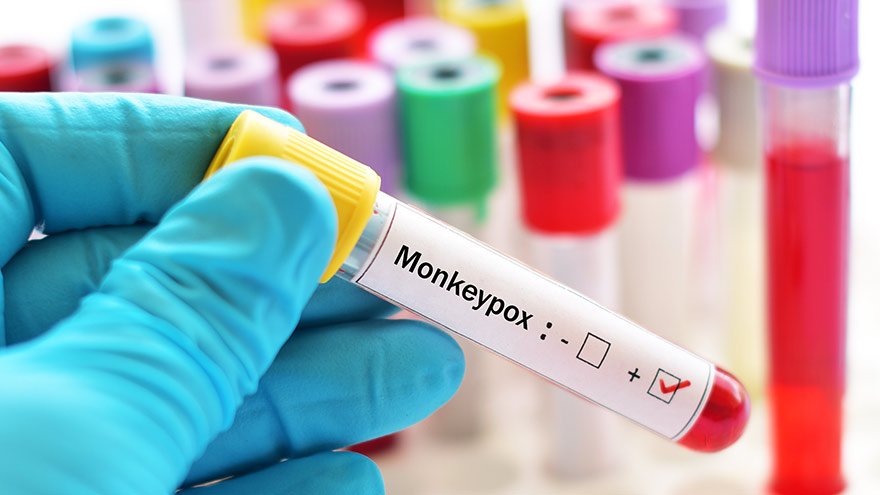 Blood sample tube positive with Monkeypox virus, new epidemic disease in 2022