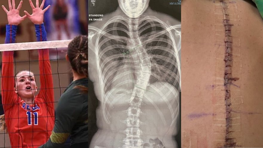 A three photo collage of Renown Children's Hospital patient Madeleine, her x-ray and her spinal surgery result.