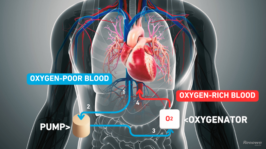 Extracorporeal Membrane Oxygenation technology graphic