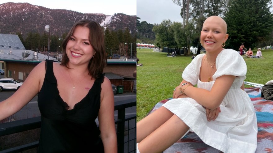 Two photos of Ava, bone sarcoma patient, side by side before and after chemotherapy.
