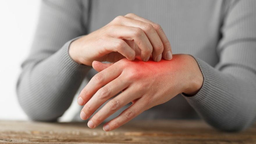 A woman with a red burn on her hand sits holding it in relief