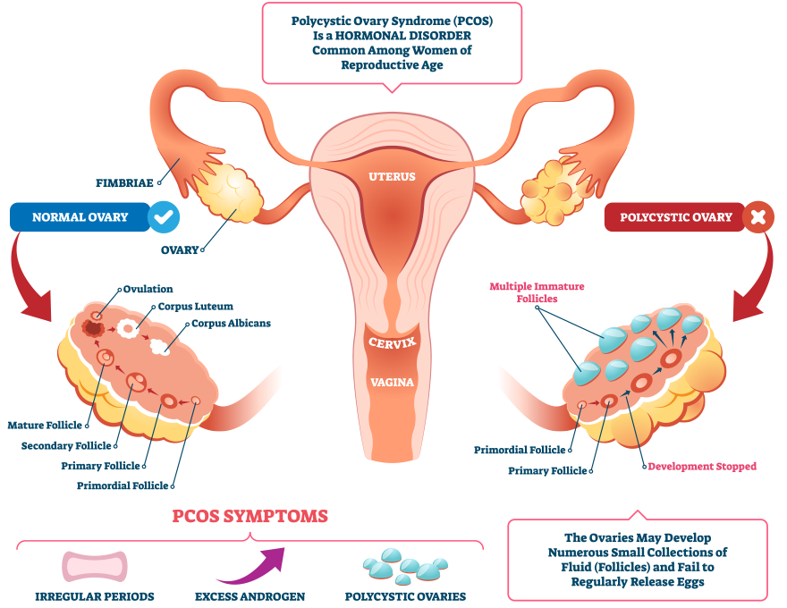 PCOS Illustration