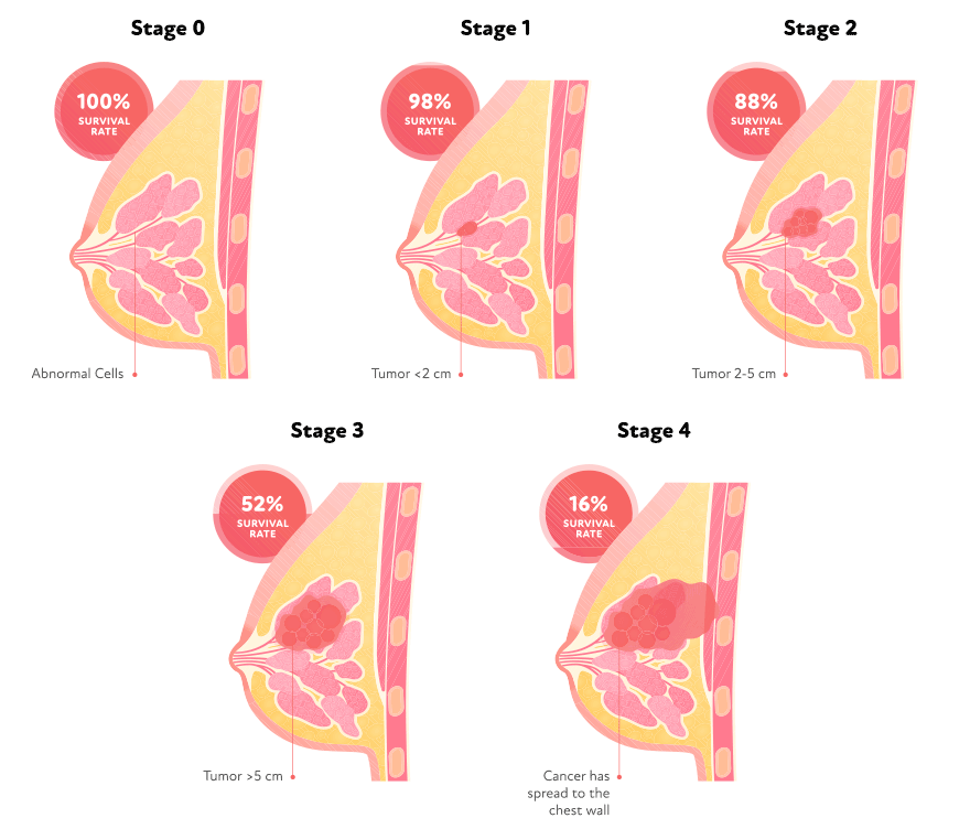 Breast cancer stages graphic