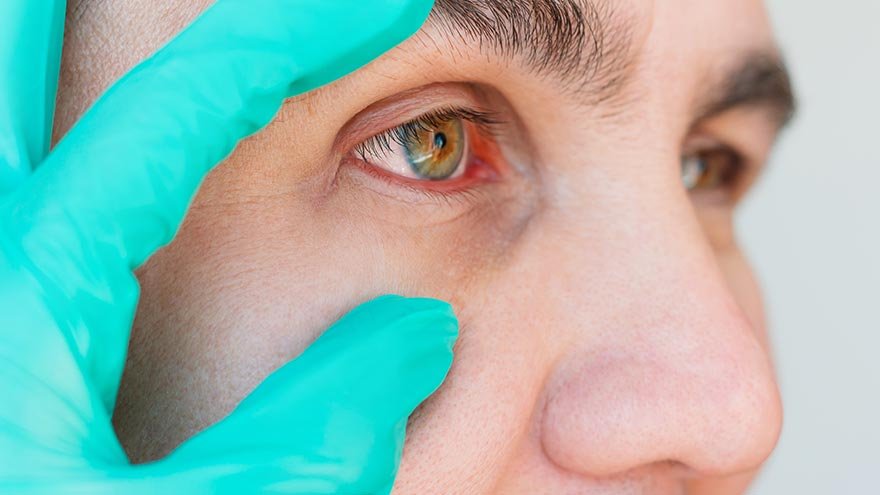 Man with pink eye having eye examined by doctor
