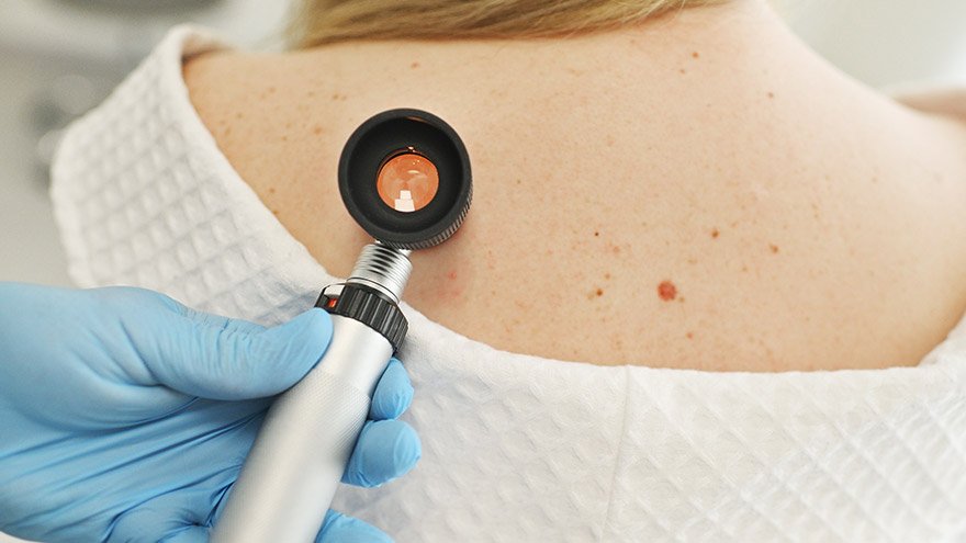 A dermatologist examines moles and skin growths on the patient's body using a special device