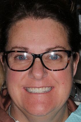 Veneers: Case 30 — after