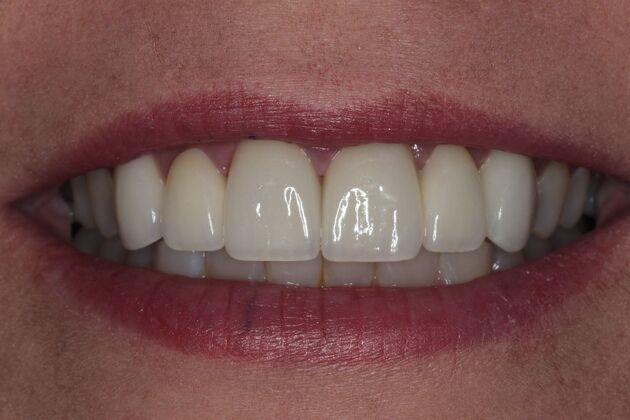 Dental Crowns: Case 34 — after