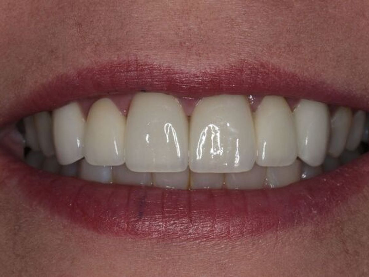 Dental Crowns: Case 34 — after