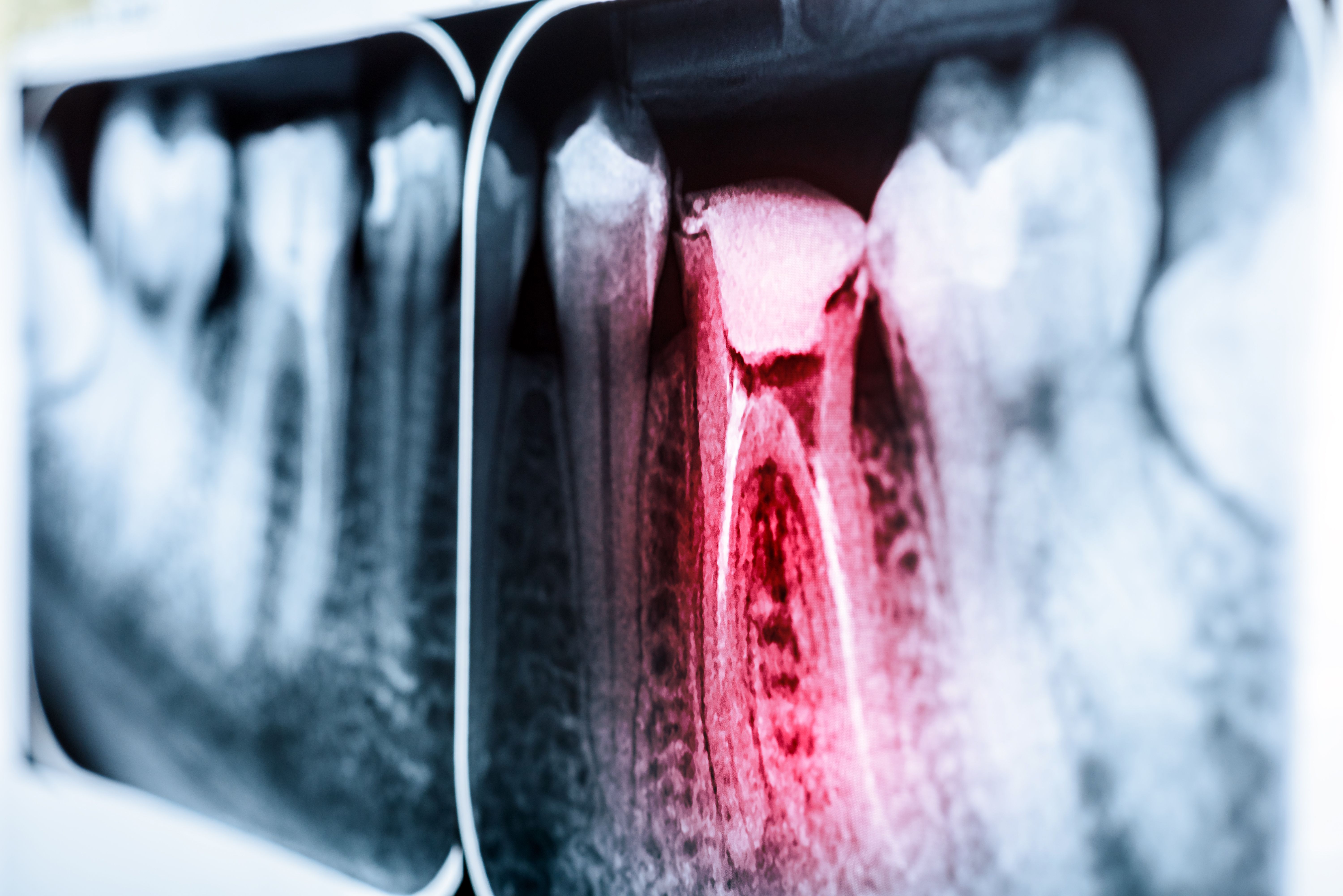 Root Canal Therapy vs. Tooth Extraction Lake Jackson, TX