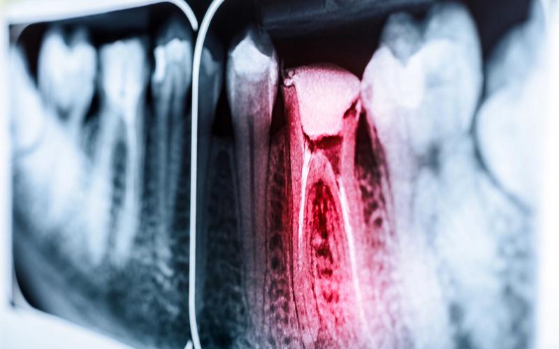 Root Canal Therapy vs. Tooth Extraction Lake Jackson, TX