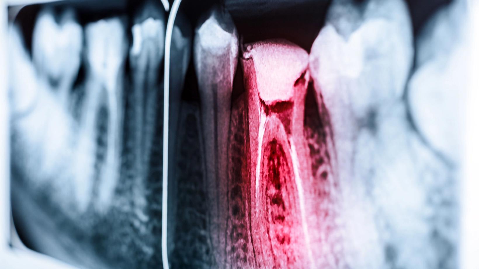 Root Canal Therapy vs. Tooth Extraction Lake Jackson, TX