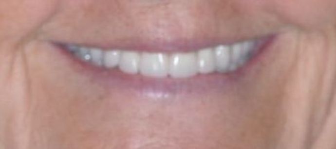 Teeth in a Day: Case 10 — Restoration before