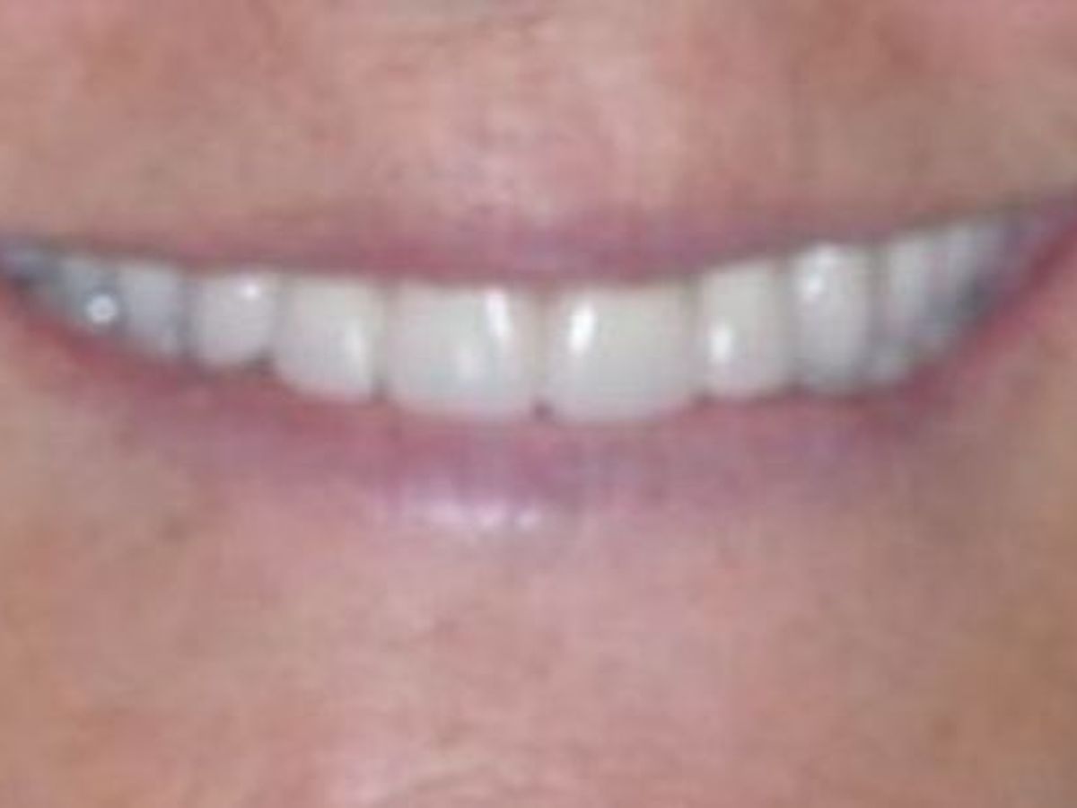 Teeth in a Day: Case 10 — Restoration before