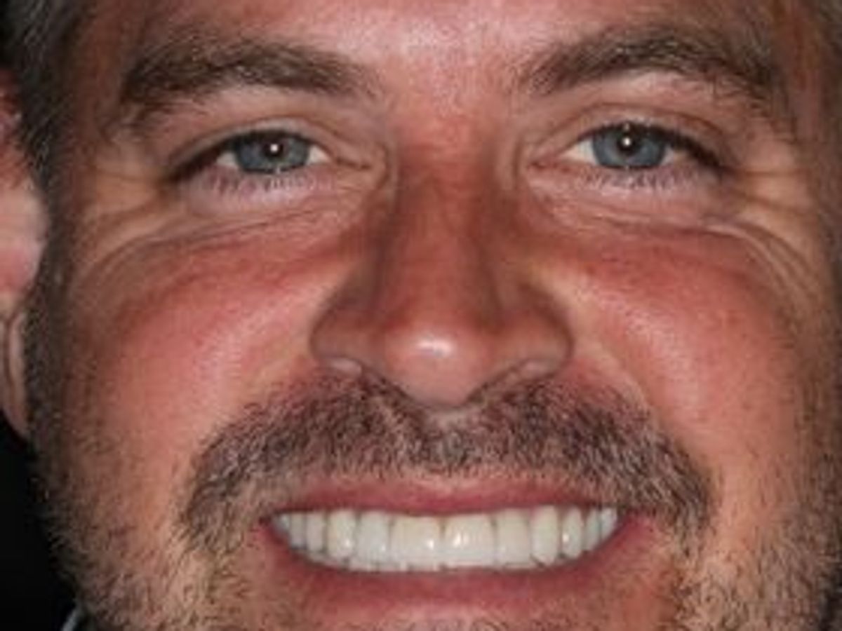 Full Mouth Reconstruction: Case 7 — after
