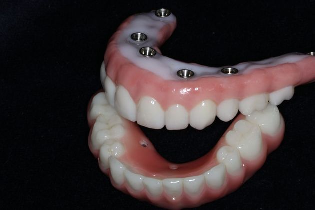 Teeth in a Day: Case 23 — Upper Lower Prosthetic / Prosthetic in Place before
