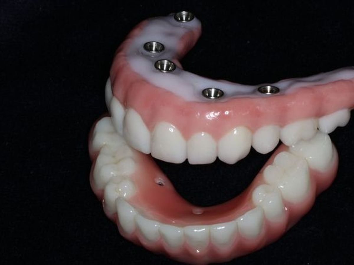 Teeth in a Day: Case 23 — Upper Lower Prosthetic / Prosthetic in Place before