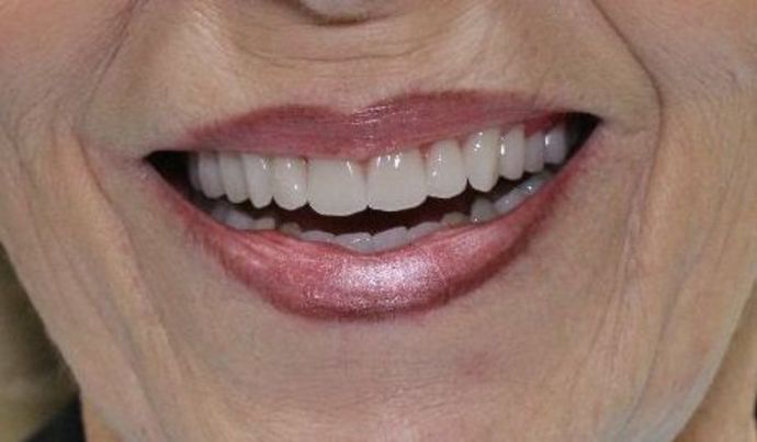 Dentures: Case 2 — after